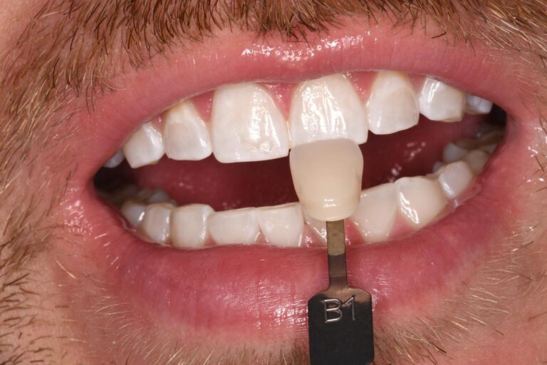 Close-up of a mouth with lips parted to reveal upper and lower teeth; a shade guide tab labeled “B1” is held against an upper front tooth to assess color match for cosmetic dental restorations.