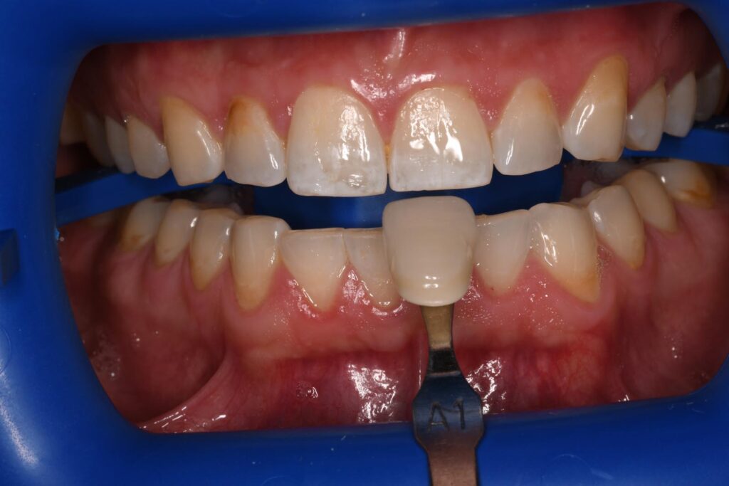 Close-up of a mouth held open with a blue dental retractor; a shade guide tab labeled “A1” is positioned against the lower central incisor to evaluate color match for cosmetic dental restorations.