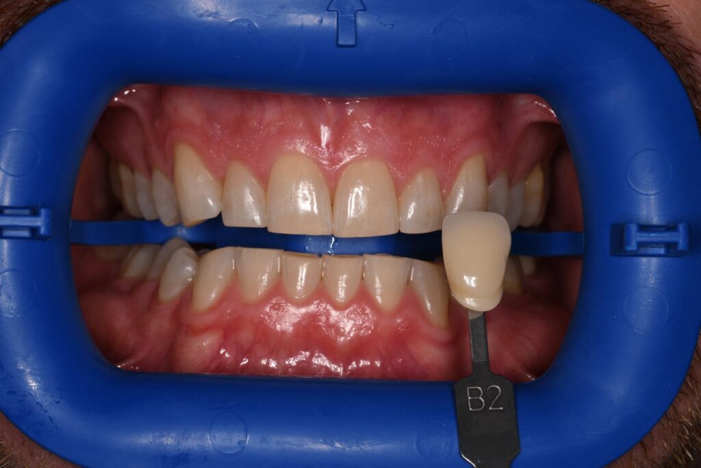 Close-up of a mouth held open with a dental cheek retractor; a shade guide tab labeled “B2” is positioned against the upper front teeth to evaluate color match for cosmetic dental restorations.