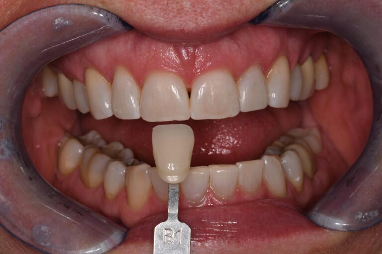 Close-up of a mouth with dental retractors exposing upper and lower teeth; a shade guide tab labeled “B1” is held against the lower front teeth to assess color match for dental restorations.