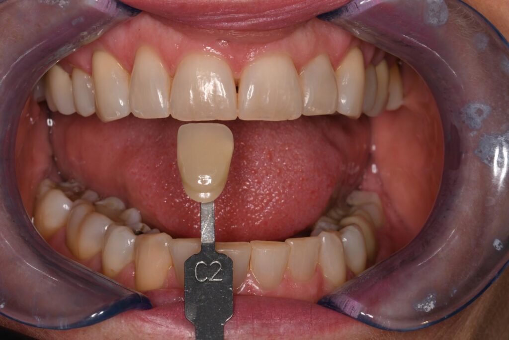 Close-up of an open mouth with a dental shade guide tab labeled “C2” held against the upper central incisors to assess color match; clean, well-aligned teeth and visible tongue suggest a cosmetic dentistry context.