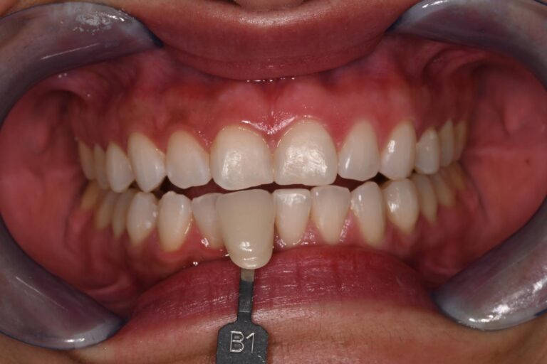 Close-up of a mouth with dental retractors exposing upper and lower teeth; a shade guide tab labeled “B1” is held against the lower central incisors to evaluate color match for cosmetic dental restorations.