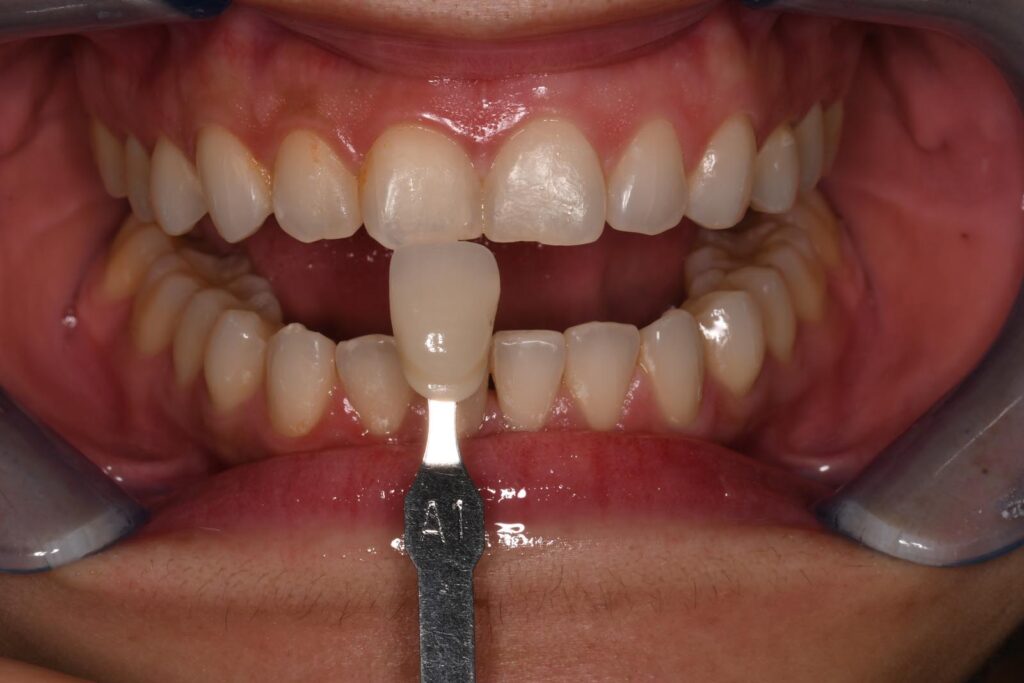 Close-up of a mouth with lips held open by a dental retractor; a shade guide tab labeled “A1” is positioned against the upper central incisors to assess color match for dental restorations.
