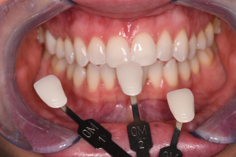 Close-up of a mouth with lips retracted to expose upper front teeth; three dental shade guide tabs labeled “OM1,” “OM2,” and “OM3” are held against the teeth to evaluate color match for cosmetic dental procedures.