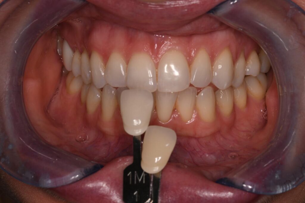 Close-up of a mouth held open with a dental retractor; two shade guide tabs labeled “1M” and one unmarked tab are positioned against the upper front teeth to assess color match for cosmetic dental restorations.