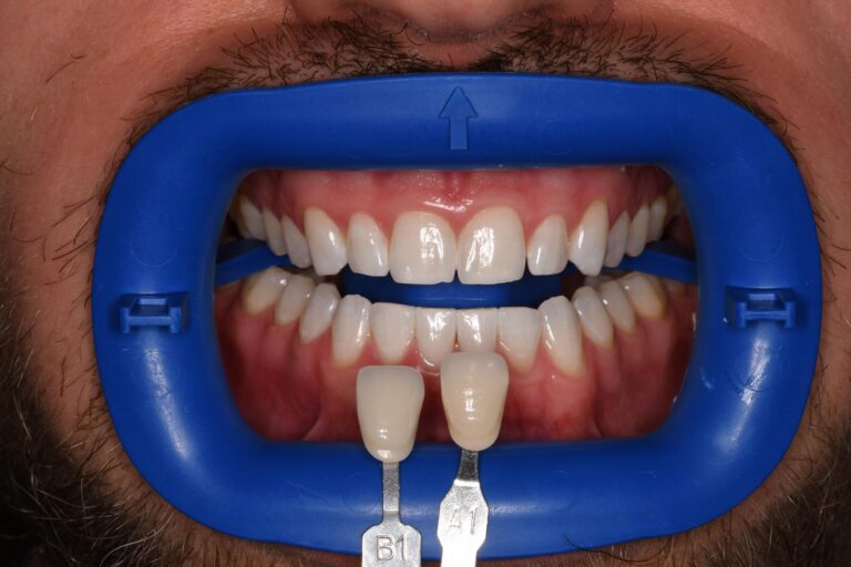 Close-up of a mouth held open with a dental cheek retractor; two shade guide tabs labeled “B1” and “1” are positioned against the upper central incisors to assess color match for cosmetic dental restorations.