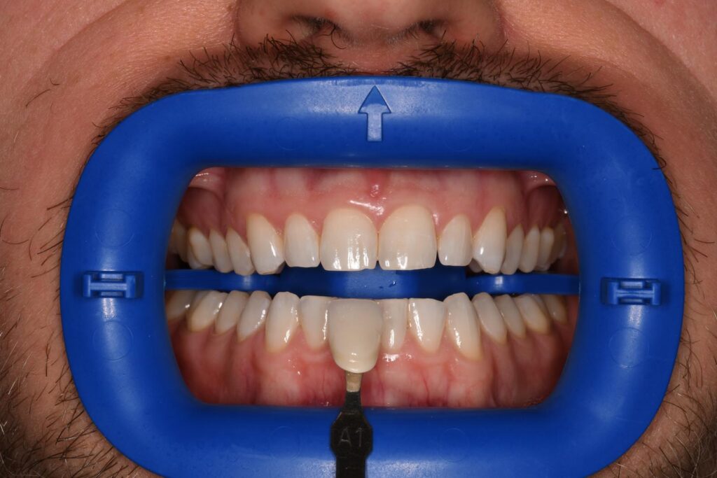 Close-up of a mouth held open with a blue dental cheek retractor; two shade guide tabs labeled “B1” and “1” are positioned against the lower front teeth to assess color match for cosmetic dental restorations.