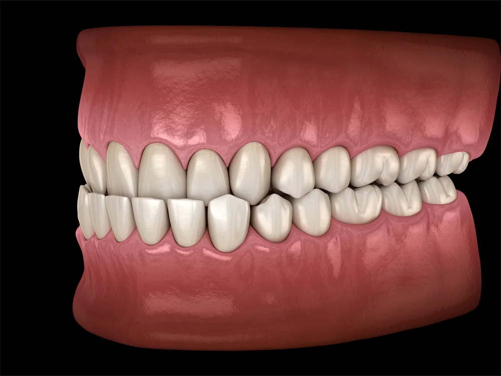 Here is the alt text for the image: 3D illustration of an underbite condition in a set of human teeth. The lower teeth are positioned in front of the upper teeth, showing a significant misalignment. The image displays a close-up side view of the teeth and gums with a black background.