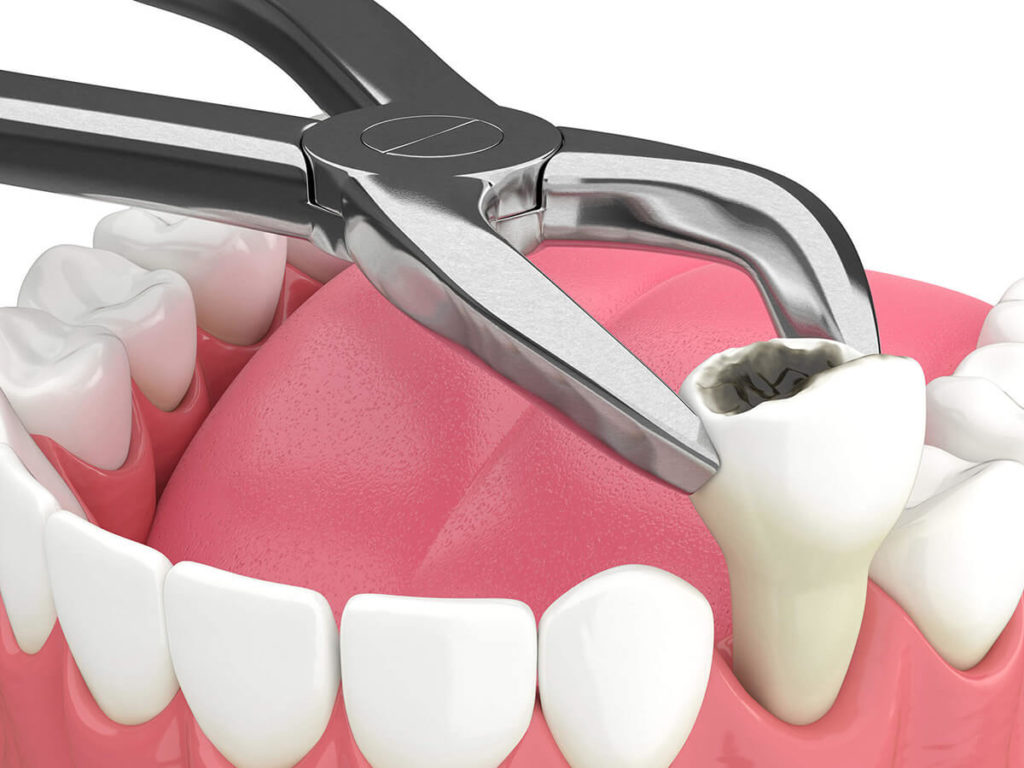 graphic of a tooth being pulled