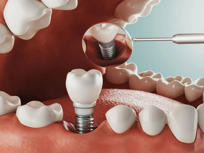 Dental implants in Waukesha, WI at Glo Dental Studio.