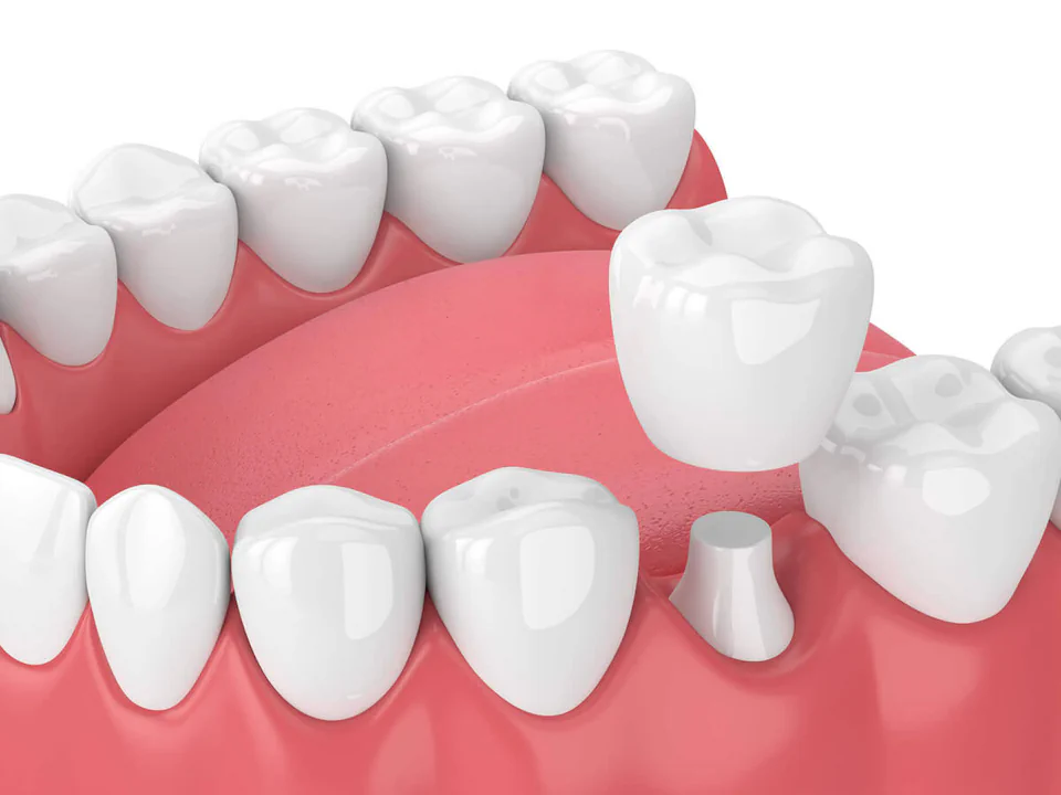 Same day dental crowns and dental bridges in Waukesha, WI at Glo Dental Studio.