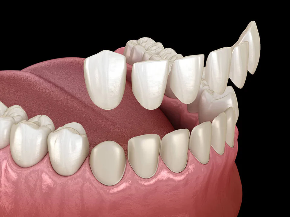Dental veneers in Waukesha, WI at Glo Dental Studio.
