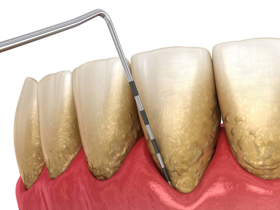 Gum disease treatment in Waukesha, WI at Glo Dental Studio.