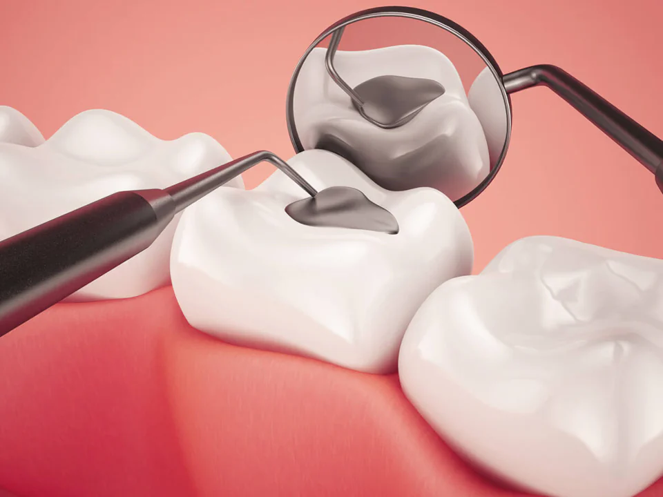Dental fillings and dental sealants in Waukesha, WI at Glo Dental Studio.