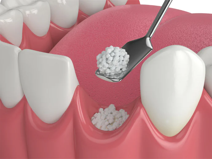 Dental bone grafting in Waukesha, WI at Glo Dental Studio.