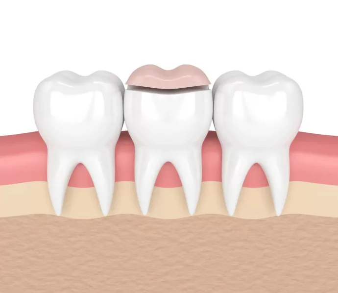 Dental inlays and dental onlays in Waukesha, WI at Glo Dental Studio.