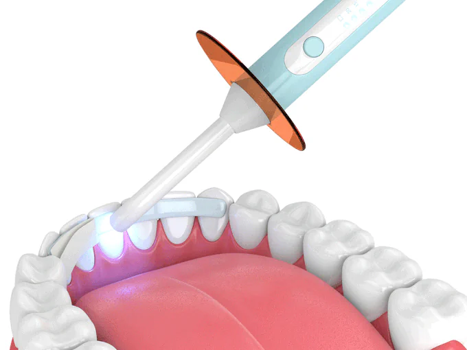 Dental bonding in Waukesha, WI at Glo Dental Studio.