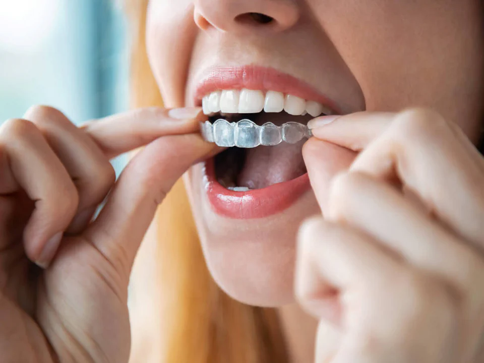 Invisalign clear aligners in Waukesha, WI at Glo Dental Studio.