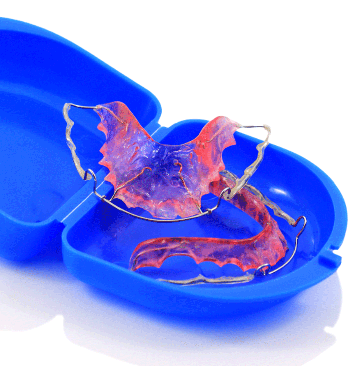 A pink and purple dental retainer with metal wires is placed inside a blue plastic retainer case. The case is open, showing the retainer's intricate design and structure against the blue background.