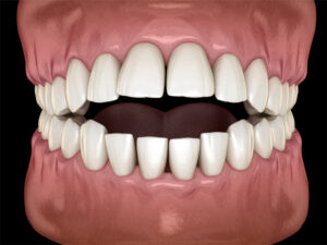 3D illustration of an open bite condition in a set of human teeth. The front teeth on both the upper and lower jaws do not touch when the mouth is closed, creating a noticeable gap. The image displays a front view of the teeth and gums with a black background.
