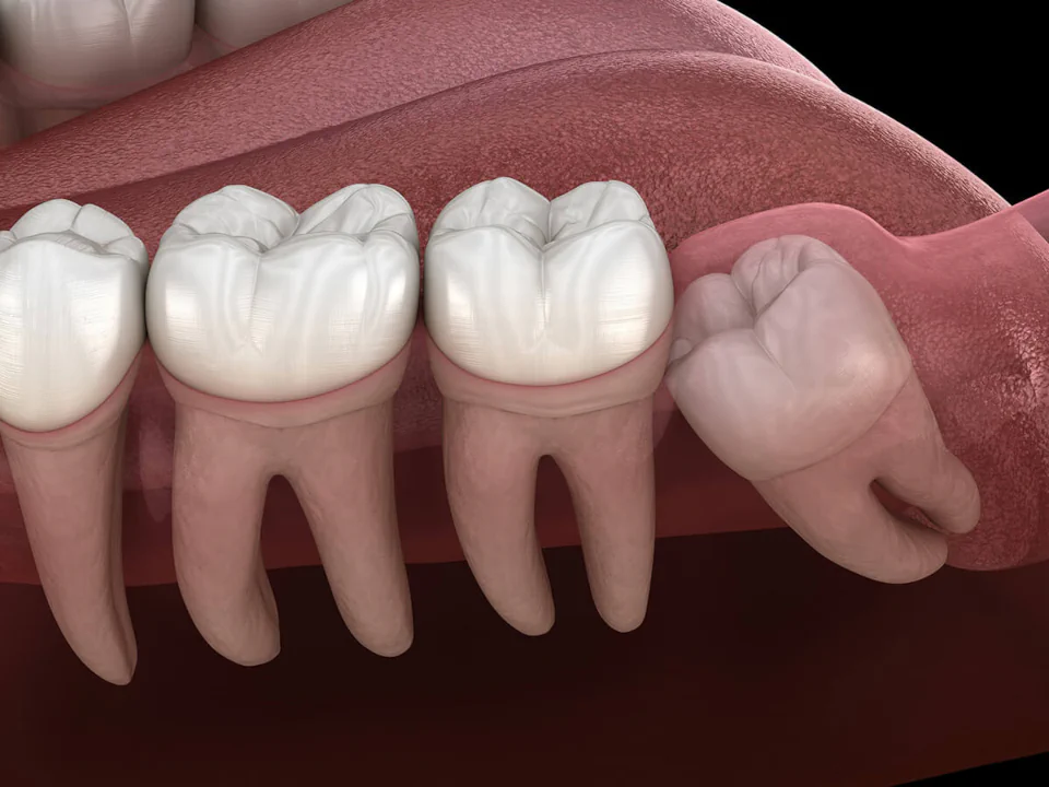 Wisdom teeth removal in Waukesha, WI at Glo Dental Studio.