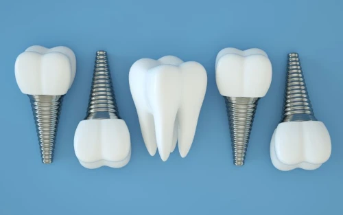 Exploring Dental Implants in Waukesha, WI at Glo Dental Studio.