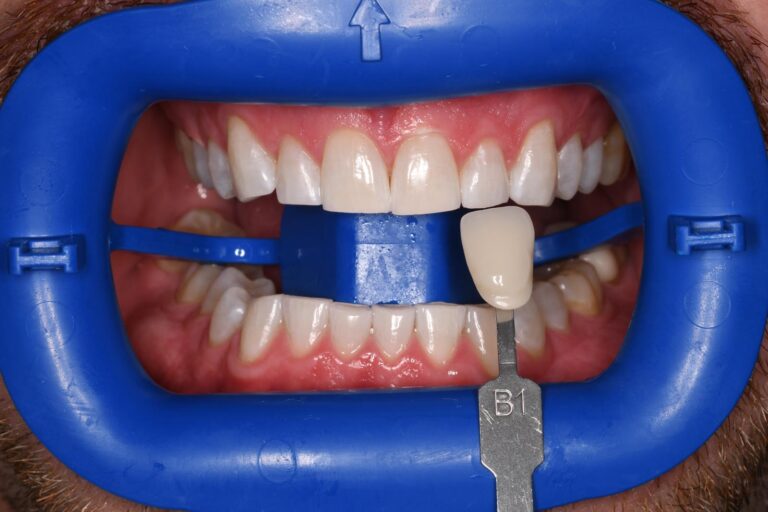 Close-up of a mouth held open with a blue dental cheek retractor; a shade guide tab labeled “B1” is positioned against the upper front teeth to assess color match for cosmetic dental restorations.