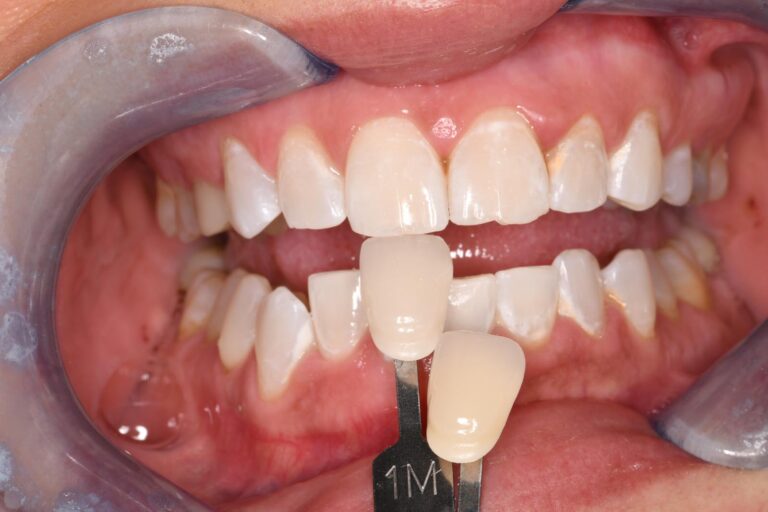 Close-up of a mouth held open with a dental cheek retractor; two shade guide tabs labeled “1M” are positioned against the upper central incisors to determine the best color match for cosmetic dental restorations.