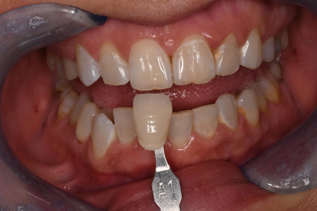 Close-up of a mouth held open with dental retractors; a shade guide tab labeled “A1” is positioned against the upper front teeth to assess color match for cosmetic dental restorations.