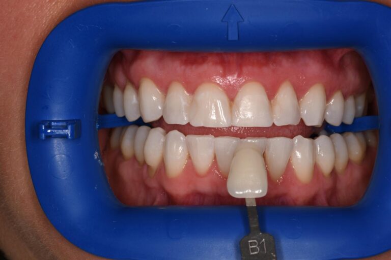Close-up of a mouth held open with a blue dental cheek retractor; a shade guide tab labeled “A1” is positioned against the lower front teeth to assess color match for cosmetic dental restorations.