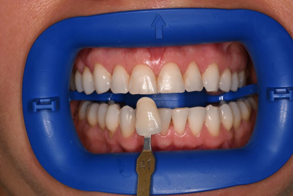 Close-up of a mouth held open with a dental cheek retractor; a shade guide tab labeled “A1” is positioned against the lower central incisors to assess color match for cosmetic dental restorations.